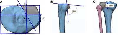 Finite element analysis of a novel anatomical plate in posterolateral plateau fractures